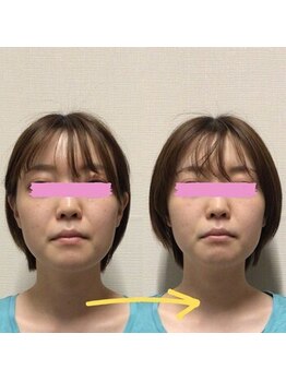 アレイズ/小顔矯正コース