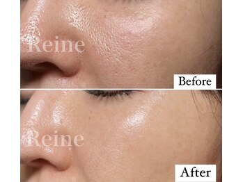 レーヌ(Reine)/白玉ピコジェット＋臍帯原液導入