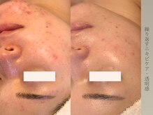 繰り返すニキビ、赤み悩みに根本改善で肌変化◎