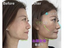 ラプリ 大宮店(Raplit)/隆鼻＋輪郭矯正40分10回