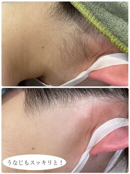 スウィート 刈谷店(Sweet)/うなじ脱毛