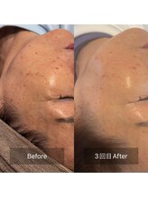 サロンツキ(salon tuki)/【光フォト】症例3回目