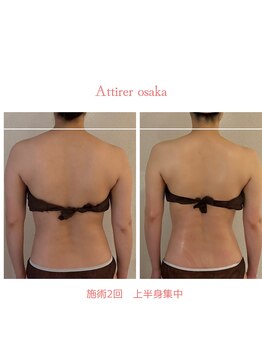 アティレ オオサカ(Attirer Osaka)/もっこり肩解消！