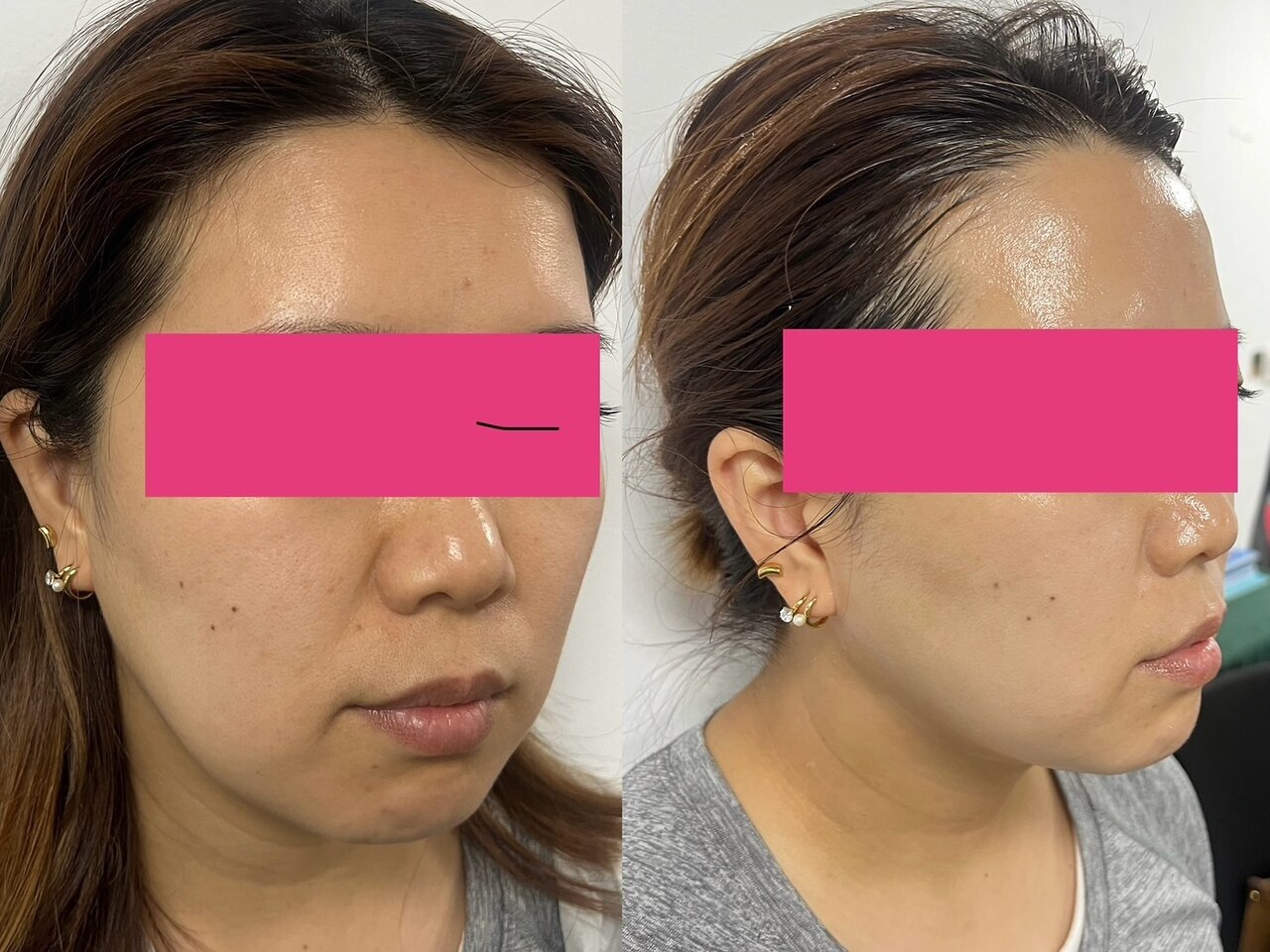 韓国スキンケア ダイヤモンドピール 韓国スキンケア ダイヤモンド