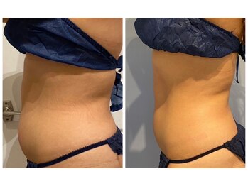 ルナグランデ 心斎橋店(Luna grande.)/お腹も引き締め