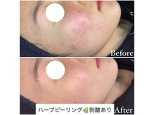 マドモアゼル 麻布十番/ハーブピーリング