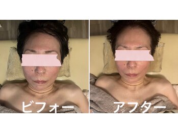 ネイチャー 新高円寺店(nature.)/別人級★小顔フェイシャル