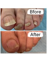 フットファースト 名古屋池下店/変形した爪も綺麗にカット◎