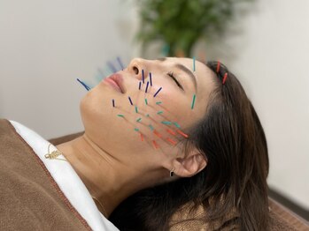 ザ ハイライト 恵比寿の写真/【美容鍼で美肌&小顔に♪】芸能人もお忍びで通う、当院の美容鍼で肌の新陳代謝を高め美肌&小顔を叶えます◎