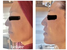 ルー ハナレ 神戸岡本 摂津本山店(Luu HANARE)/フェイスライン小顔　３回