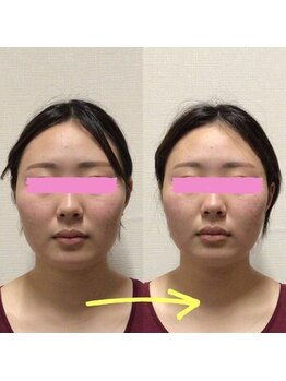 アレイズ/小顔矯正コース