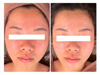 ホワイトアクア 四日市店(WHITE AQUA)/頑固なニキビケアも改善