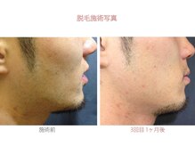 ロイ 梅田茶屋町店(LoY)/顔脱毛