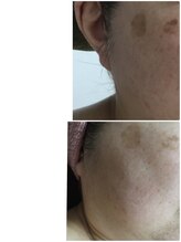 メンズアンドレディース エステティックサロン ティアラ(TiaLa)/気になるシミも効果的♪