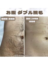 ビビユー(bibi u)/お腹ダブル脱毛ビフォーアフター