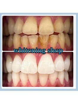 ホワイトニングショップ 堺東店/【ビフォーアフター】10回