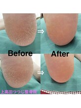 上高田つつじ整体院/フットケア　角質ケア
