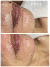 リー(REE)/フェイシャルWax脱毛