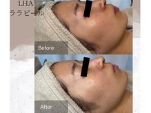 ベルーテ 田町三田(Bellute)/第4世代ピーリング★ララピール