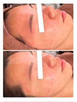 ホワイトアクア 四日市店(WHITE AQUA)/頑固なニキビケアも改善