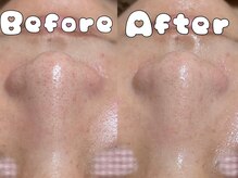 グラシア 倉敷店(Gracia)/ハイドラ毛穴洗浄