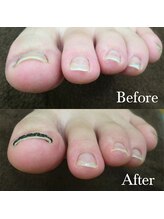 オーガニックネイルサロン プティ ボア(petit bois)/【巻き爪矯正】1回目