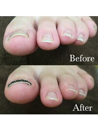 【巻き爪矯正】1回目