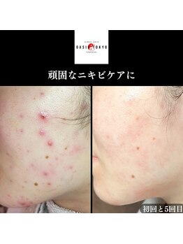 オアシス トウキョウ 川崎店(OASIS TOKYO)/幹細胞ハーブピーリング