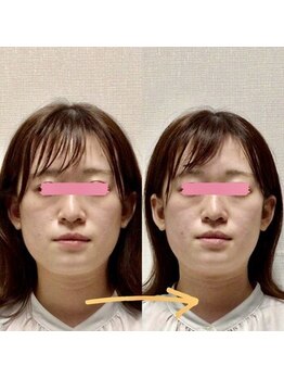 アレイズ/小顔矯正コース