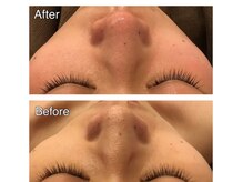 リジュベ(Rejuve)/毛穴/毛穴洗浄/船橋エステ/男性