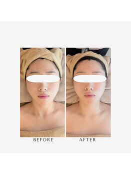 フィル 名駅店(fil)/撮影前は必須なfil小顔コルギ