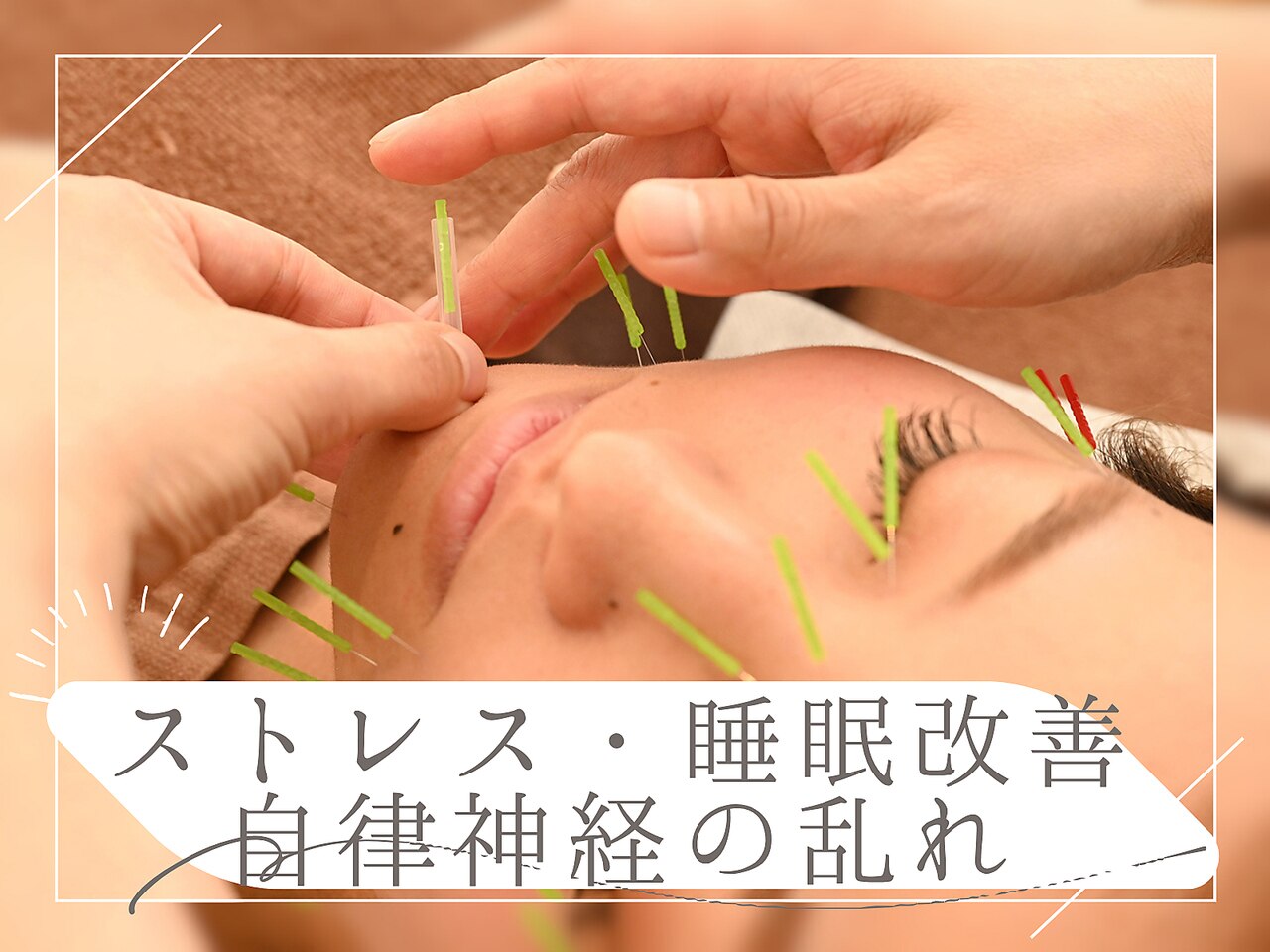 【5月限定】ストレス・睡眠改善◎美容鍼×極上ヘッド  \7,000→\2,980