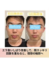 タクボディバランス/エラに特化！輪郭本格改善コース