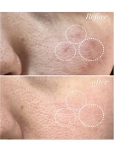 レシェルサロン(Lechelle Salon)/最新　ダクトピーリング