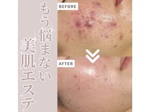 ニーナ(217)/【ニキビ改善】碧ハーブ酸ピール