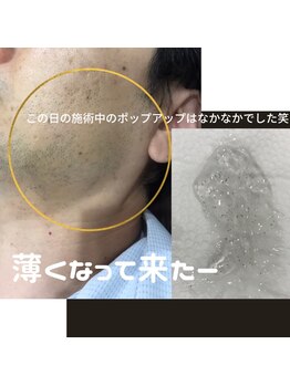 エル(AILE)/~after(4回目脱毛)