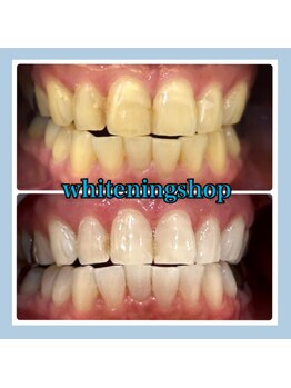 ホワイトニングショップ 堺東店/【ビフォーアフター】10回