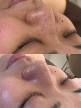 ソラ(sora)/ハイドロ・毛穴の症例★