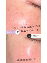 アンフィニ 麻布十番(Infini)/ヒト幹細胞フェイシャル