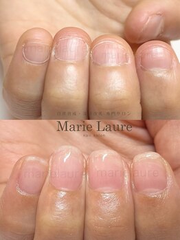 マリーロール 梅田店(Marie Laure)/深爪矯正/自爪育成/自爪風