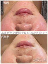 サロンドエテ(salon de ete)/繰り返すニキビケア