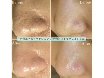 ソウ 新宿(SOU)/毛穴施術も大得意&高評価◎