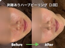 リソルバイスリール(Re:sol by sourire)/毛穴洗浄・ハーブピーリング専門