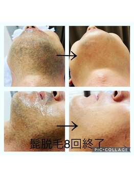 ボルベール(volver)/結果重視　メンズ髭脱毛