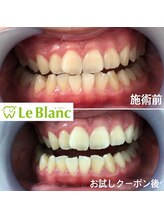 ルブラン 奈良店(Le Blanc)/簡単セルフホワイトニング
