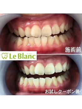 ルブラン 奈良店(Le Blanc)/簡単セルフホワイトニング