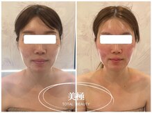 美極 銀座店/銀座/小顔コルギ/小顔矯正