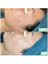 ちらちゅら/クリスティーナ【施術4回】経過