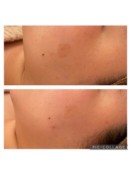 エミュ(emu)/ハーブケア　before/after