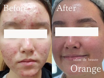 サロンドボーテ オランジュ(salon de beaute Orange)/繰り返すニキビケア